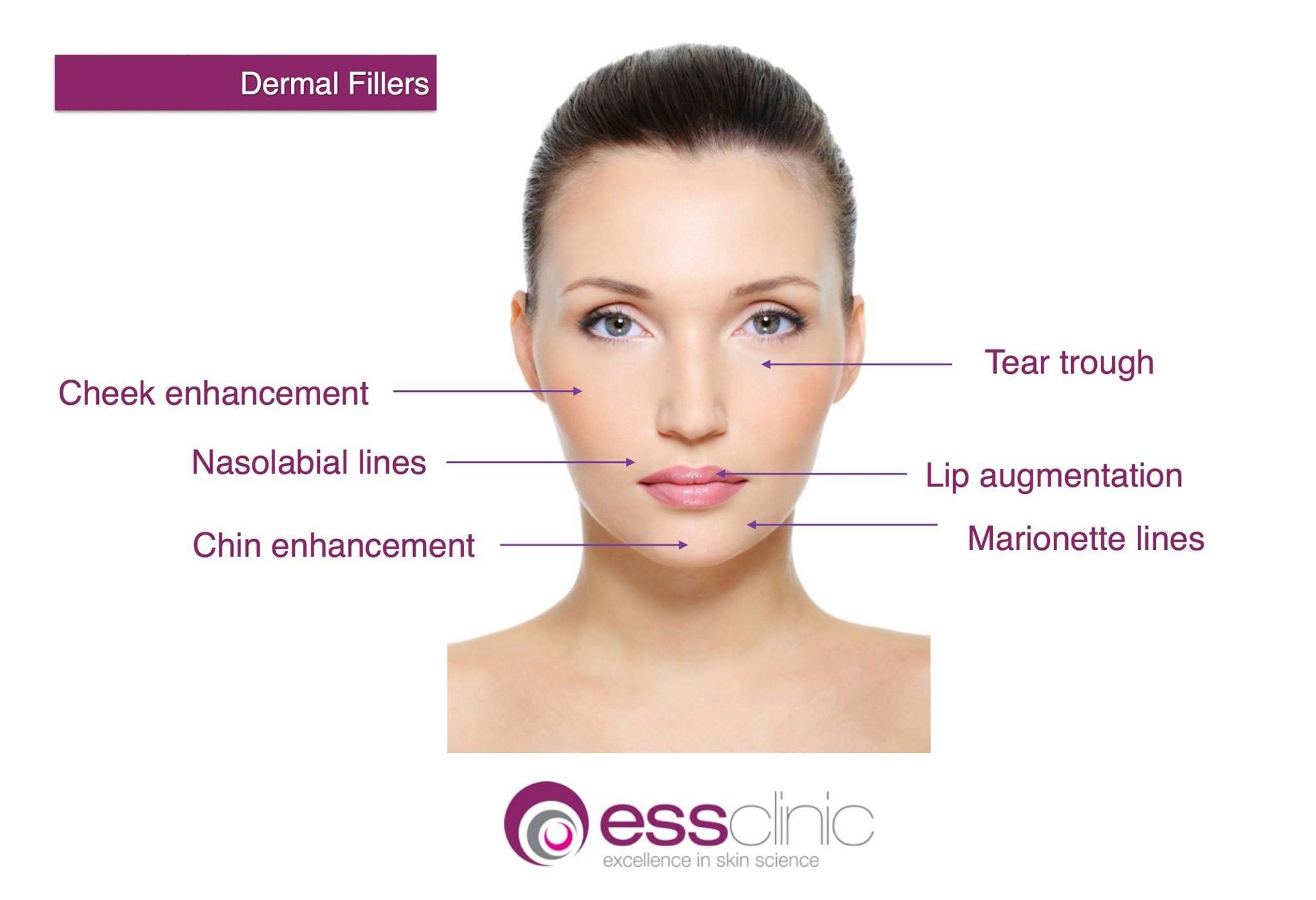 Dermal filler treatments are used to correct volume loss on the face. 